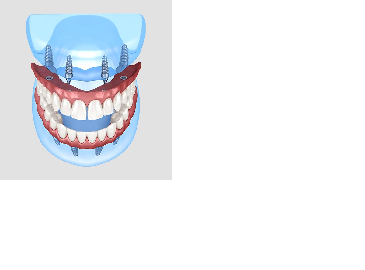 Implantes y dientes fijos en un día