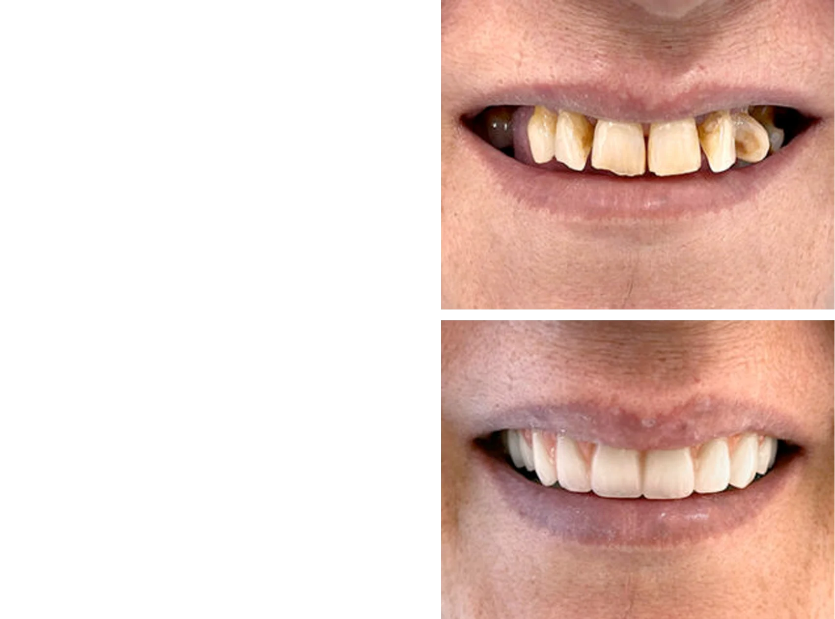 Implantes y dientes fijos en un día - IGB Dental