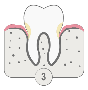 Periodoncia. Imagen fase 3