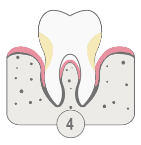 Periodoncia. Imagen fase 4