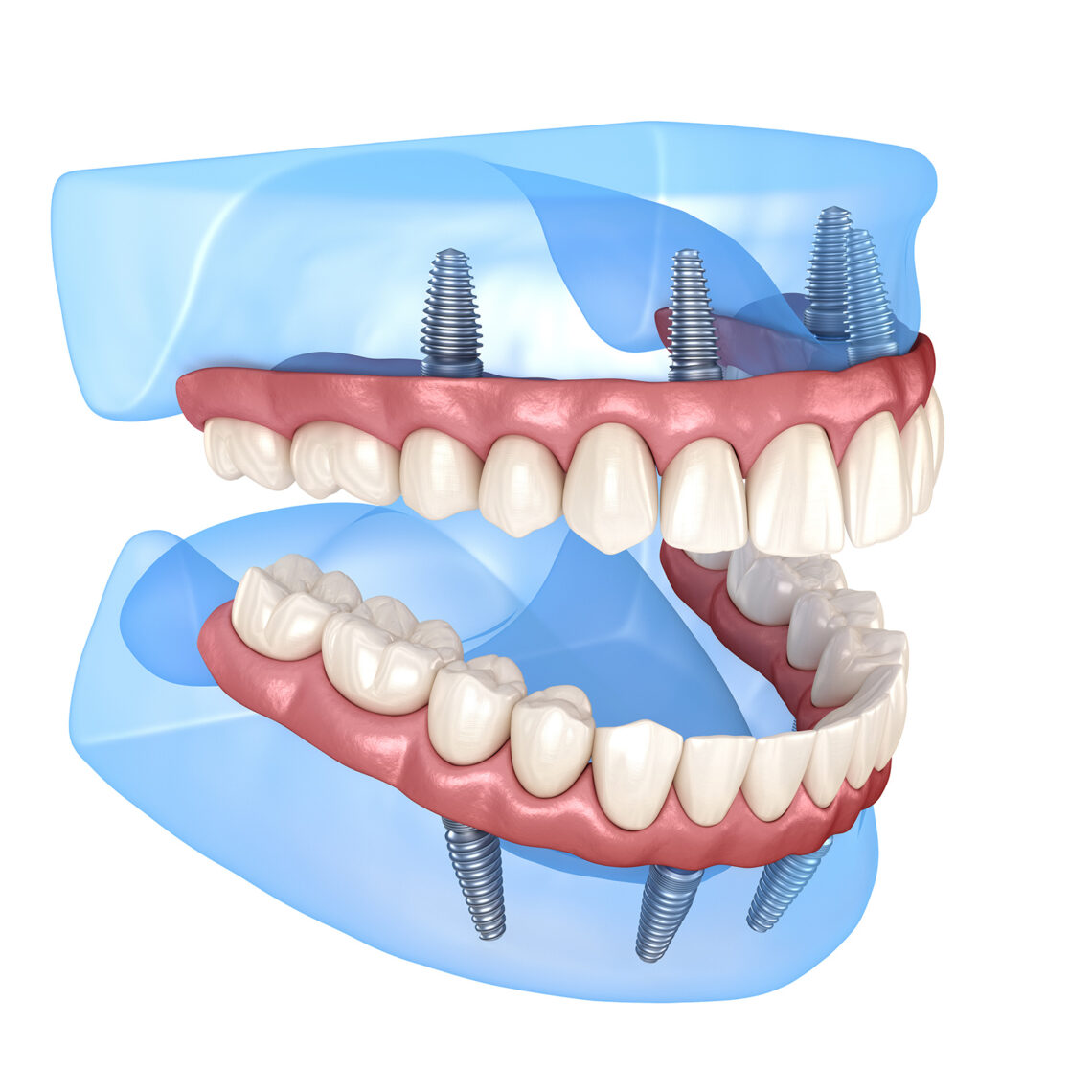 Cuánto cuesta ponerse implantes en toda la boca