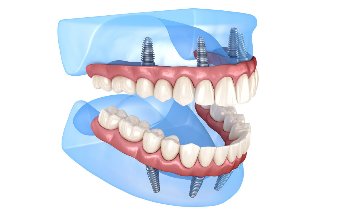 Cuánto cuesta ponerse implantes en toda la boca