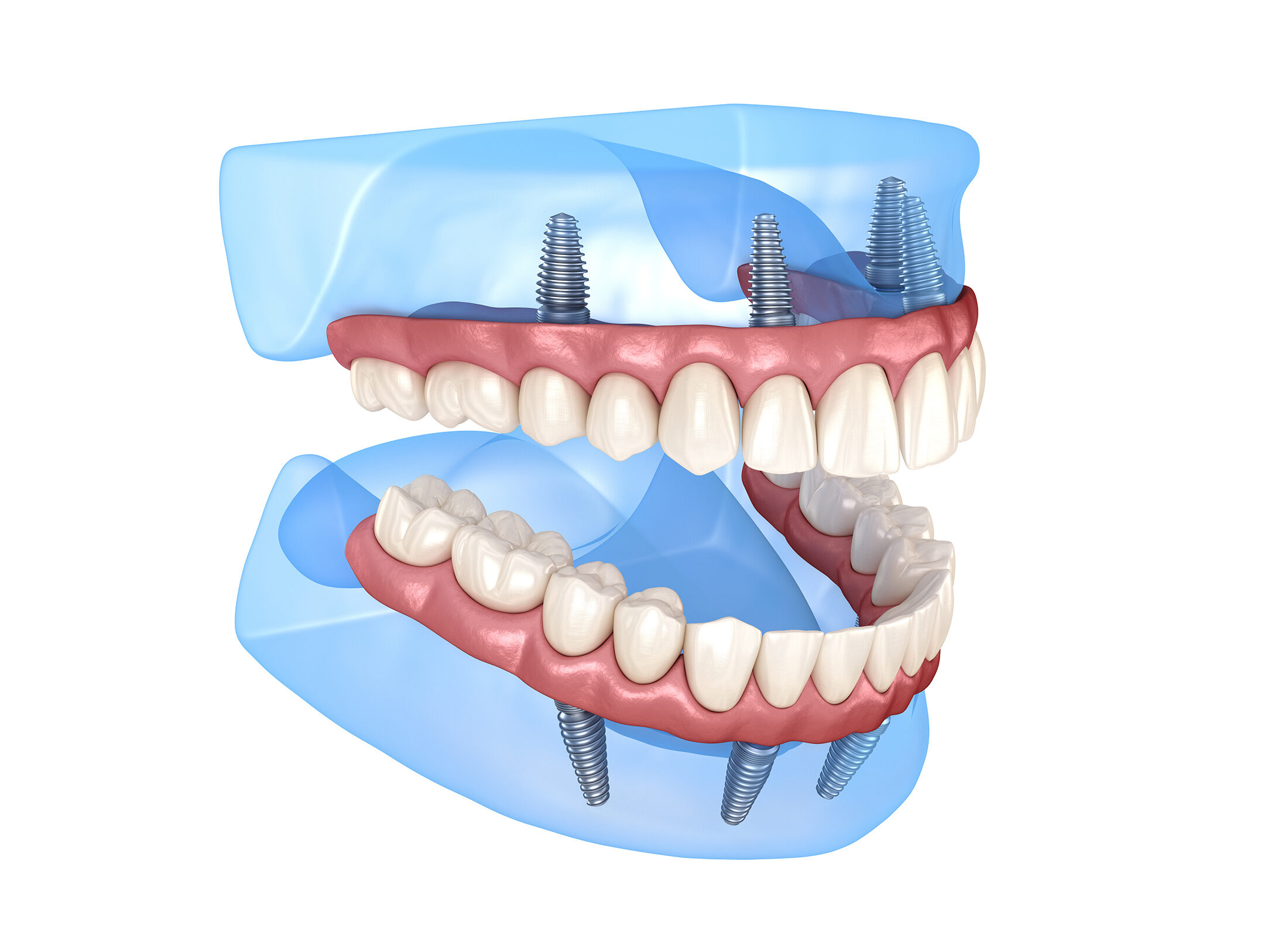 Cuánto cuesta ponerse implantes en toda la boca