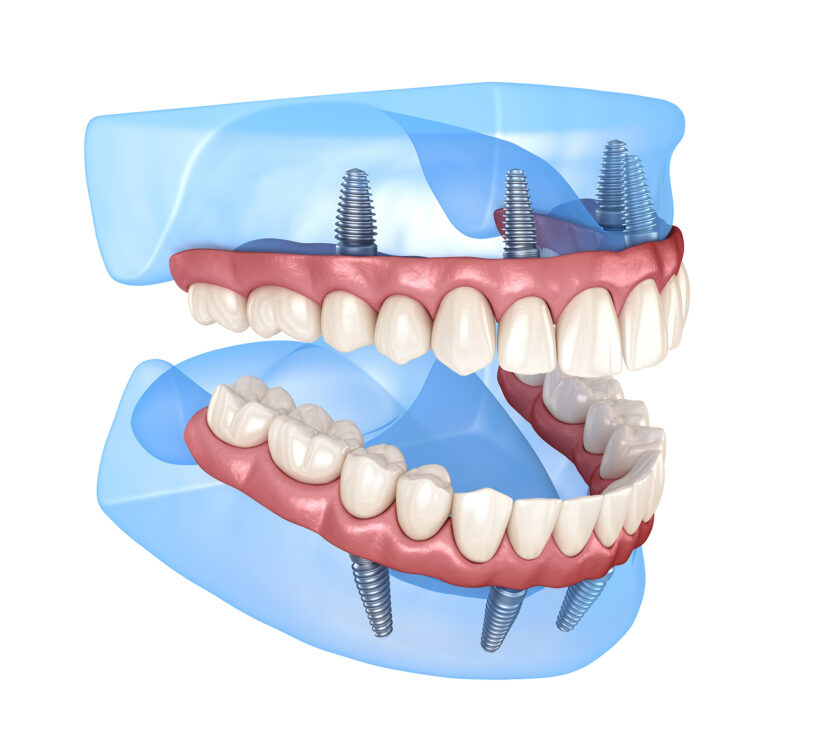 Cuánto cuesta ponerse implantes en toda la boca