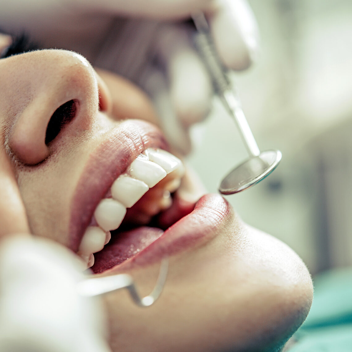 ¿Qué es un curetaje dental?