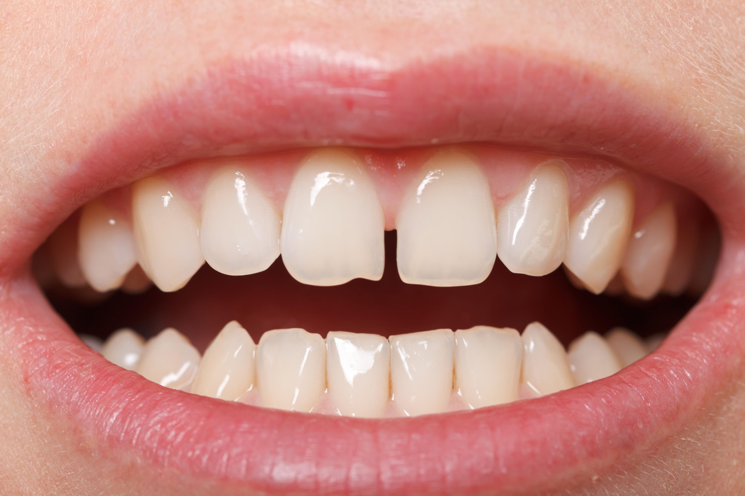 Diastema. Cómo corregir los dientes separados.