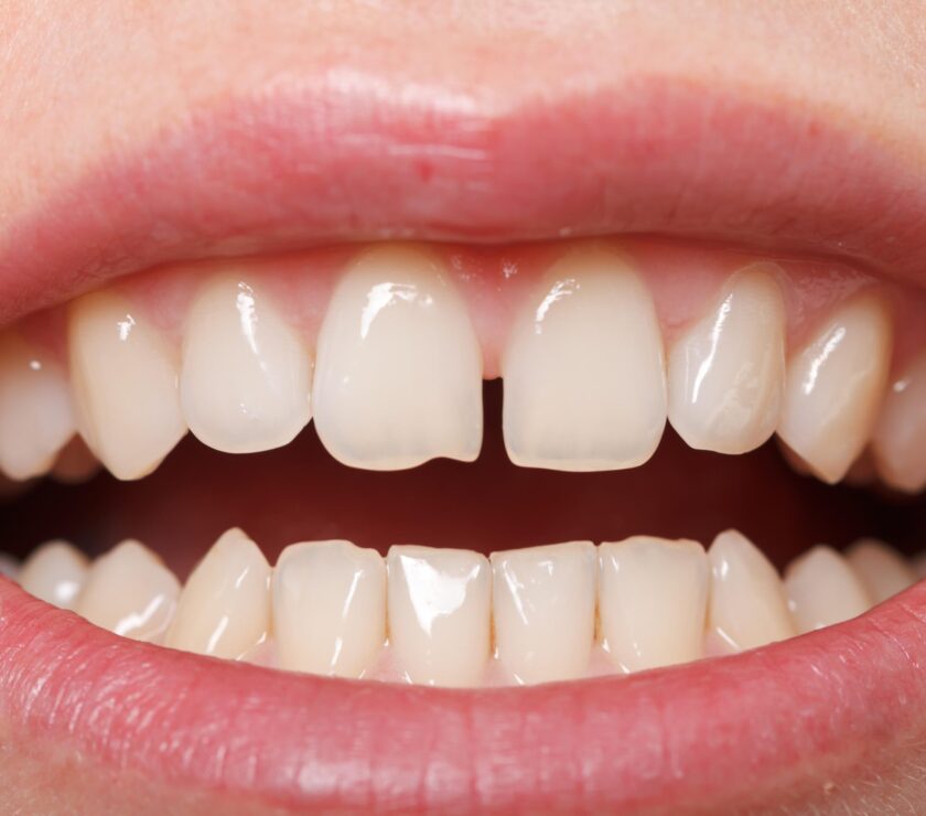 Diastema. Cómo corregir los dientes separados.