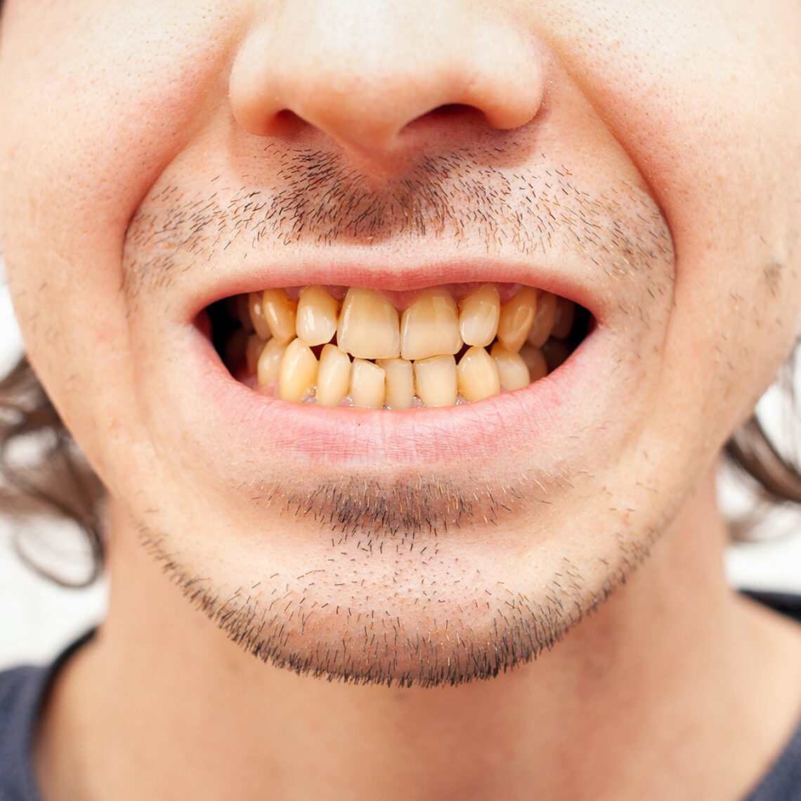 dientes amarillos