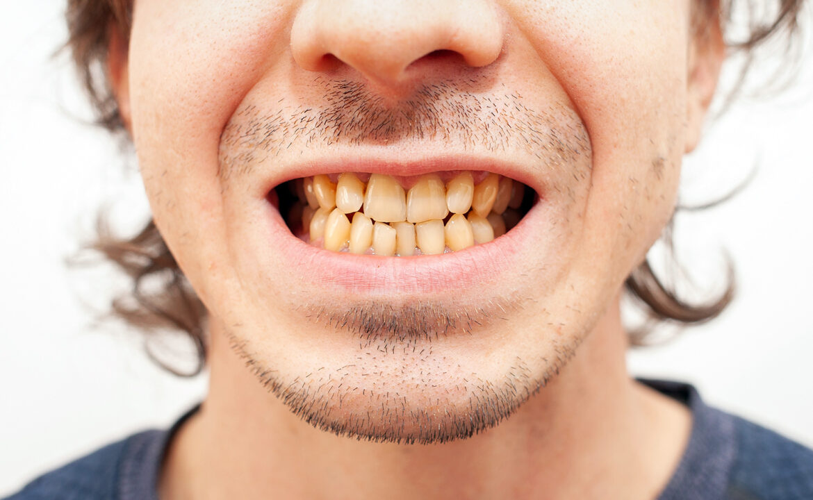 dientes amarillos