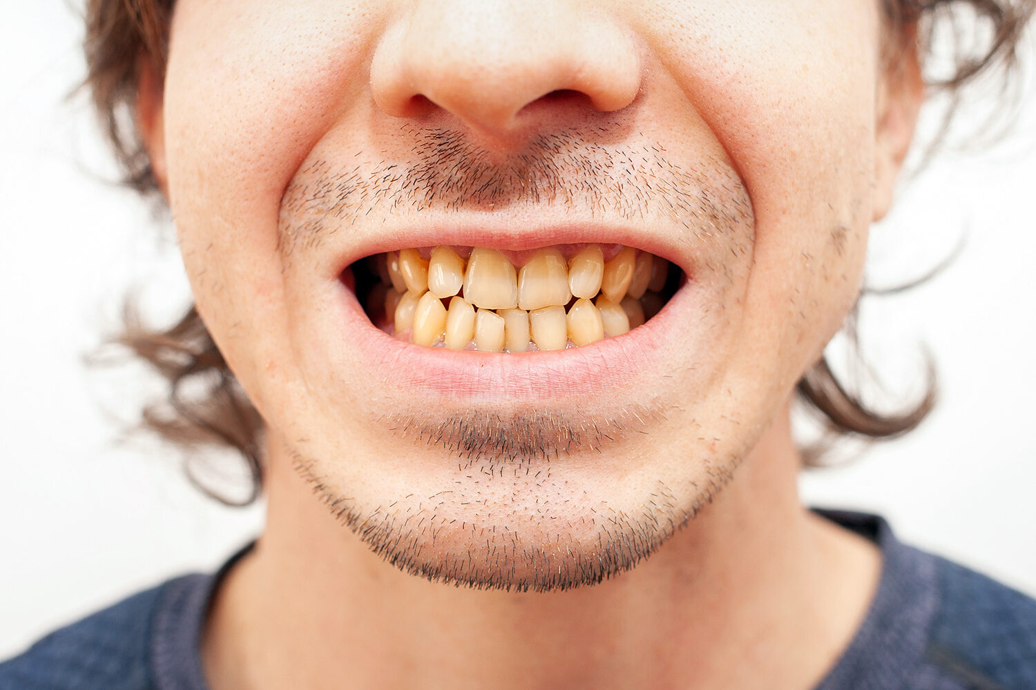 dientes amarillos