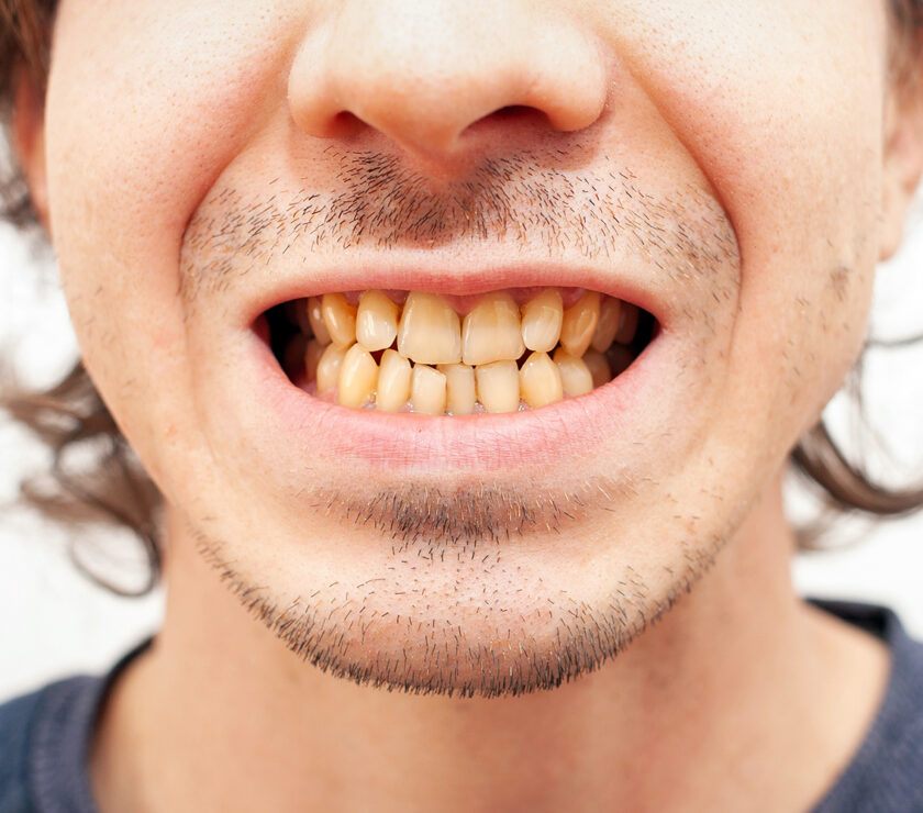 dientes amarillos