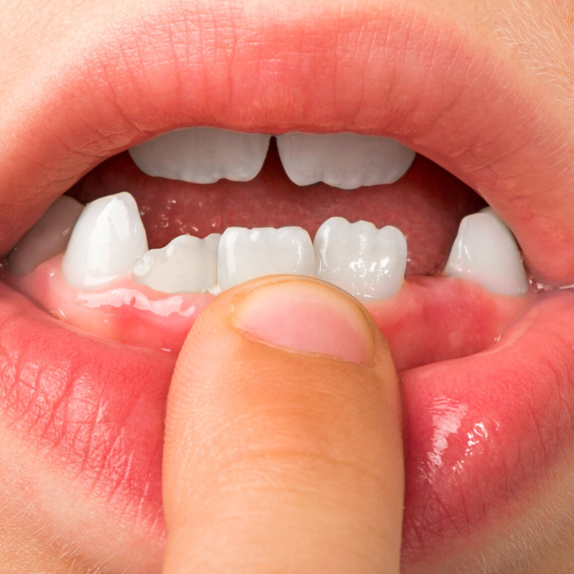 dientes leche