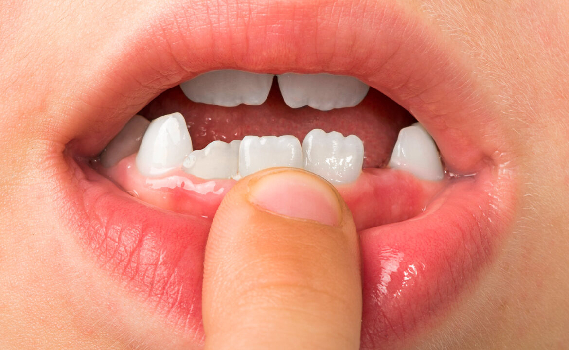 dientes leche