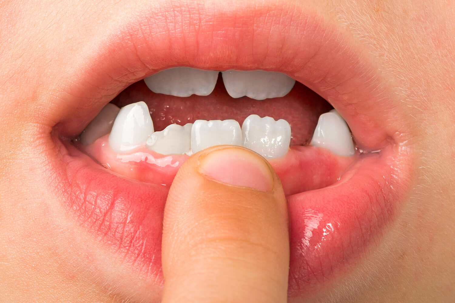 dientes leche