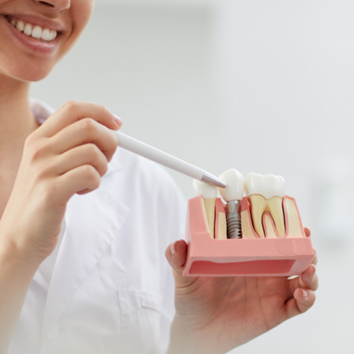 implante dental implantología