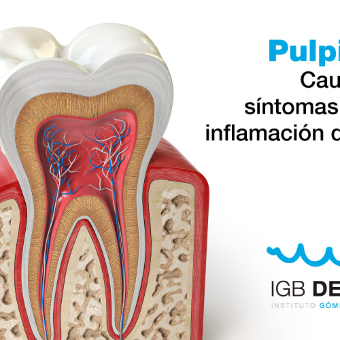 pulpitis inflamación dental