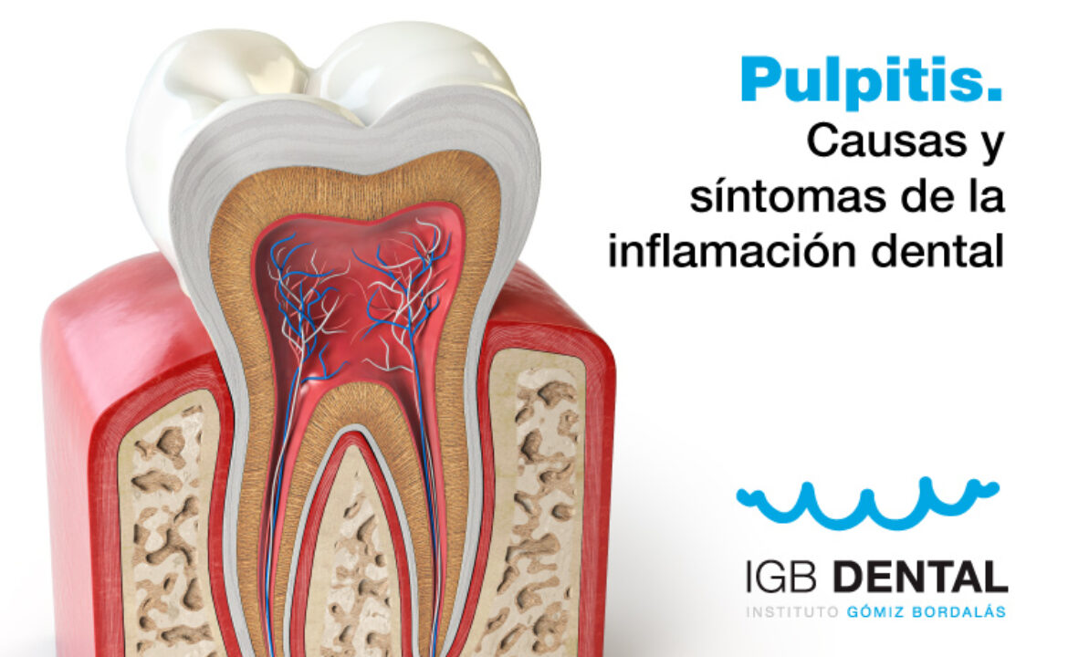 pulpitis inflamación dental