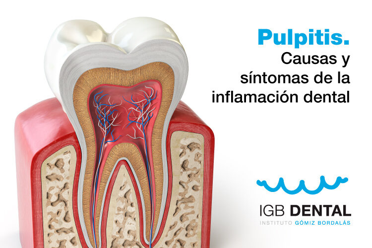 pulpitis inflamación dental
