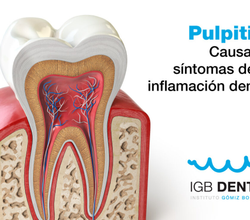 pulpitis inflamación dental