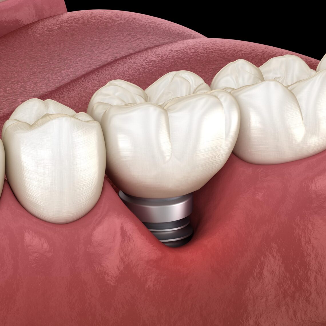 Periimplantitis. Implantes dentales