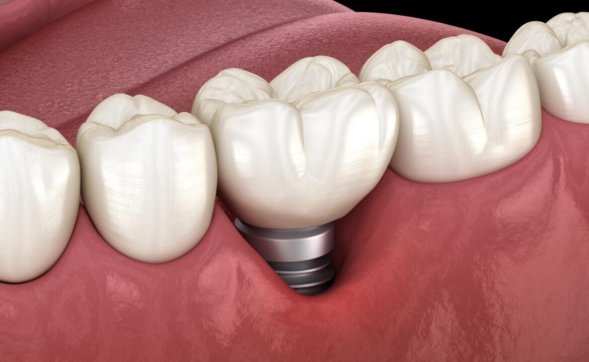 Periimplantitis. Implantes dentales