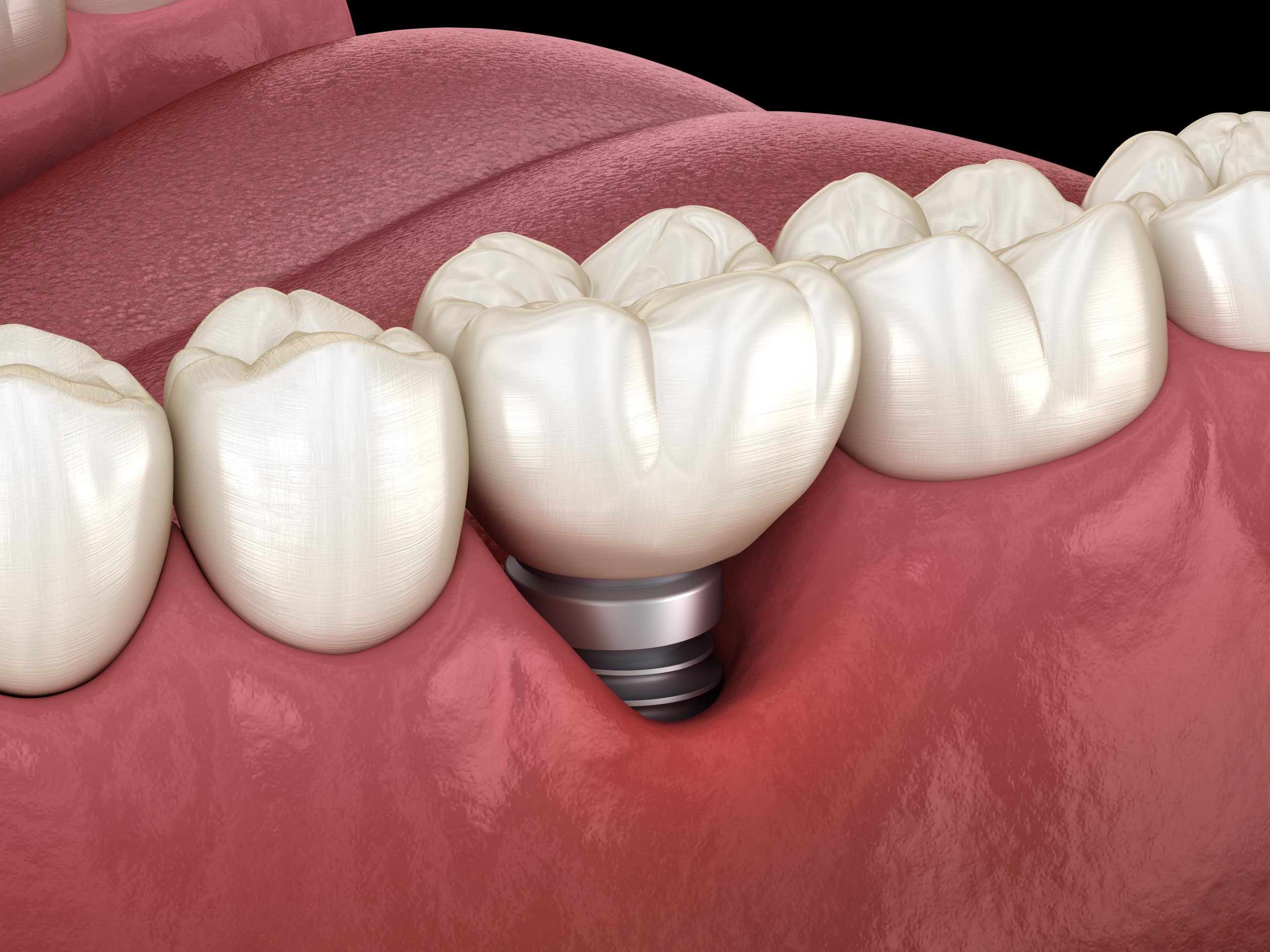 Periimplantitis. Implantes dentales