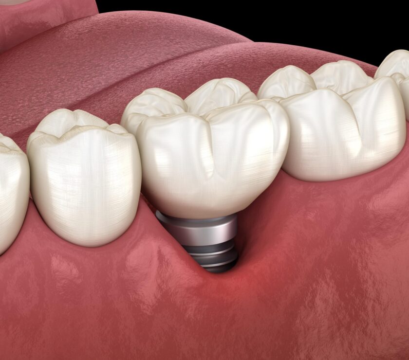 Periimplantitis. Implantes dentales
