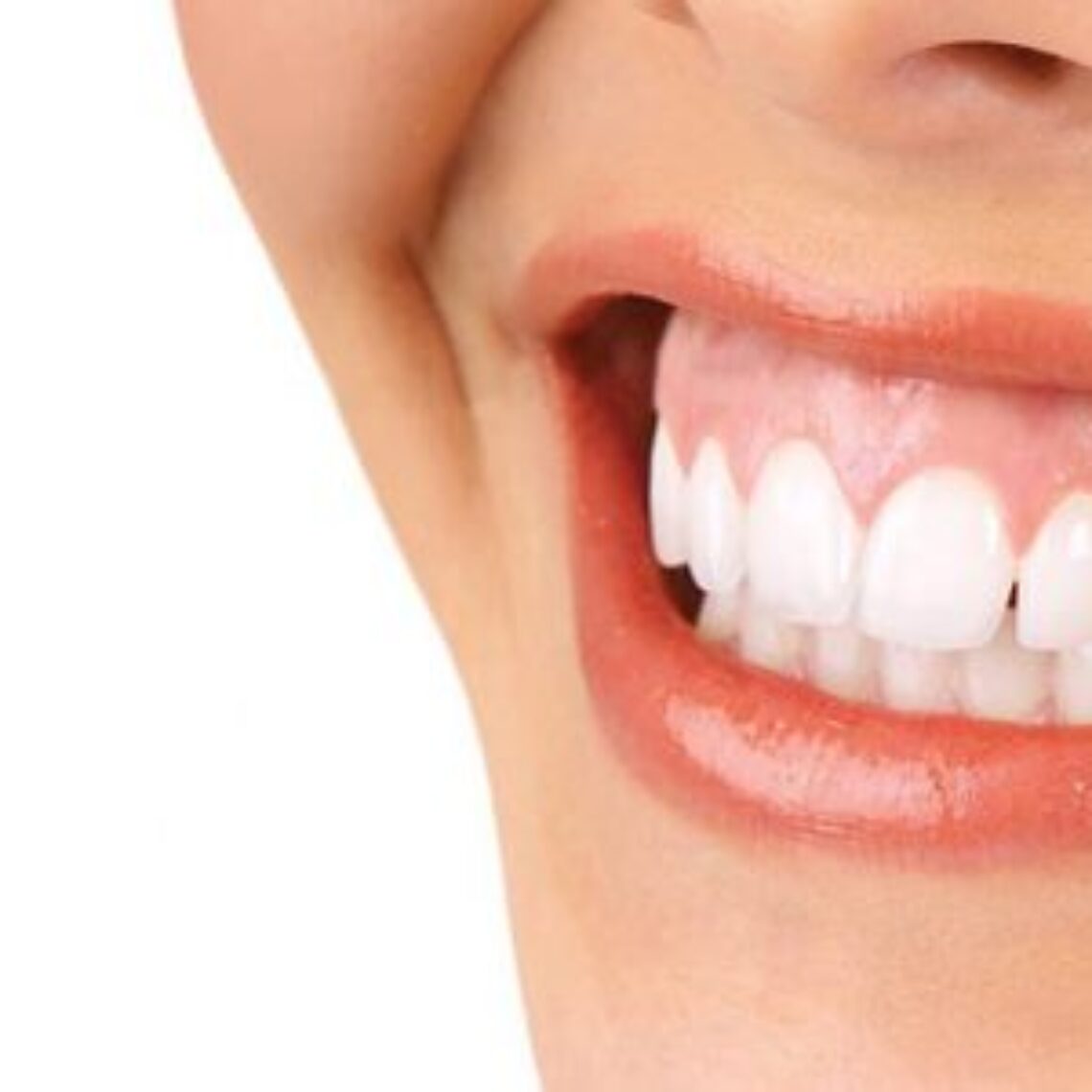 Sonrisa gingival.