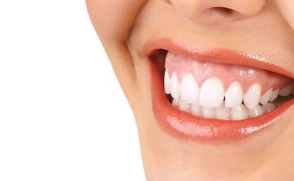 Sonrisa gingival.