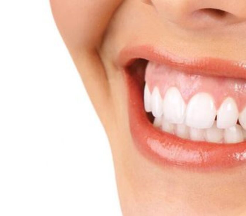 Sonrisa gingival.