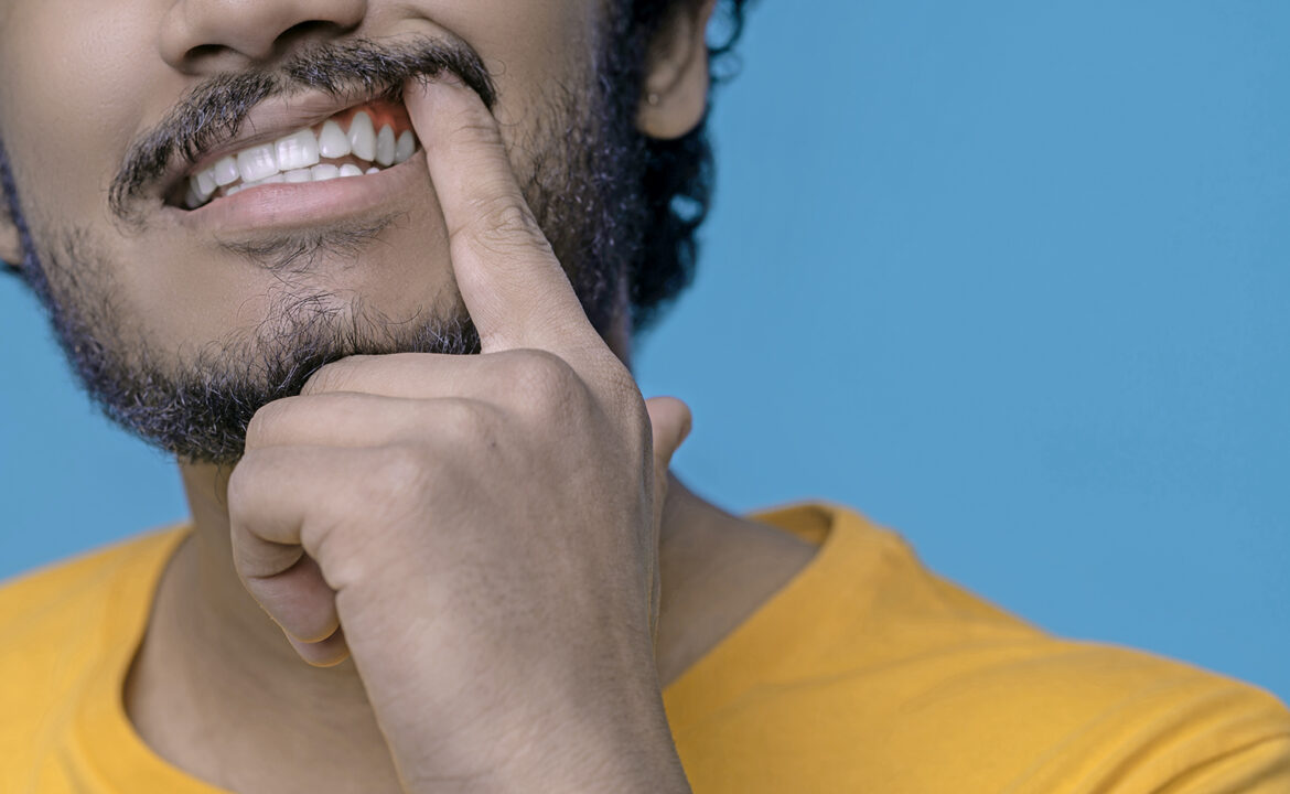 gingivitis