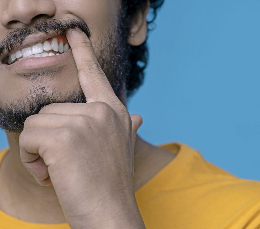 gingivitis
