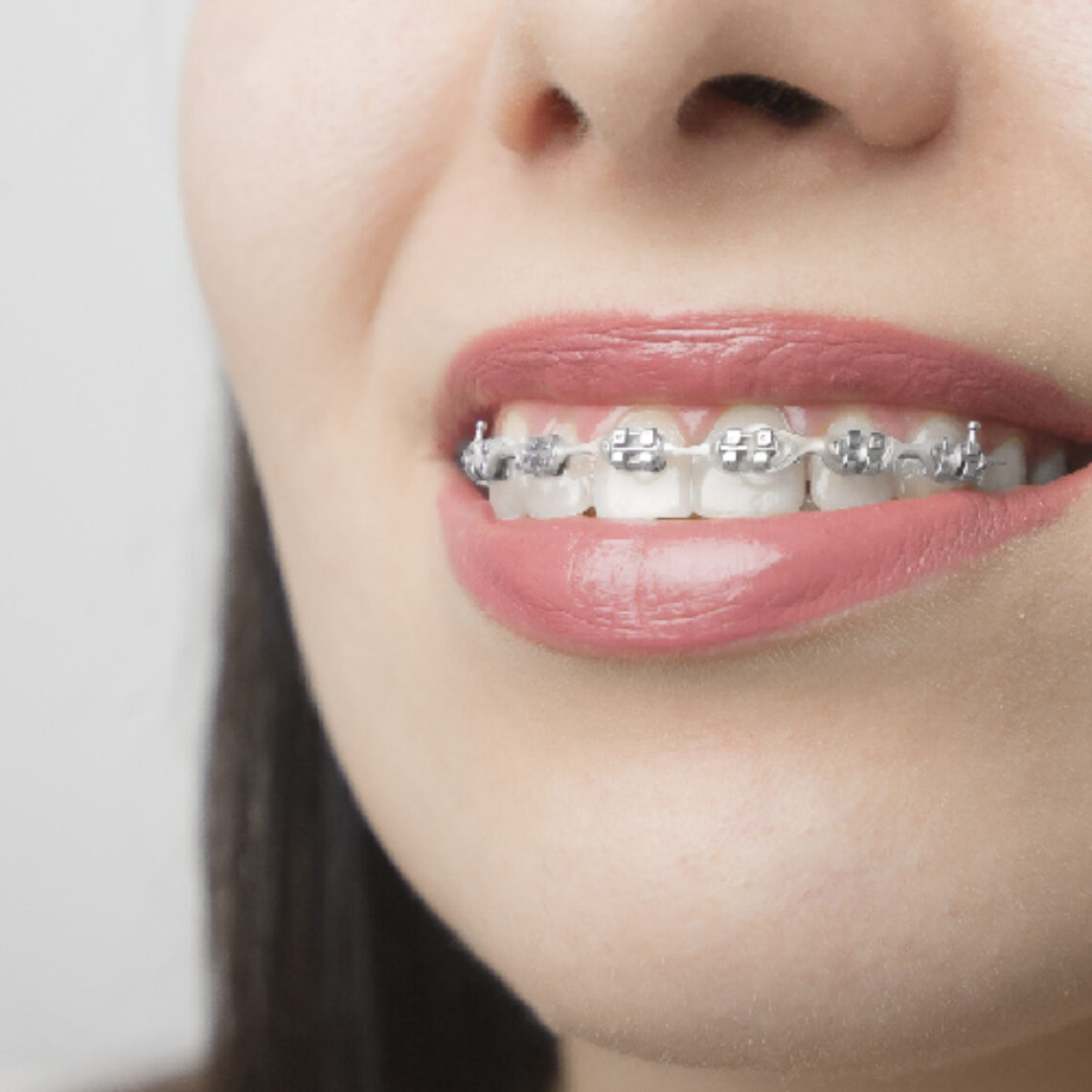 brackets ortodoncia