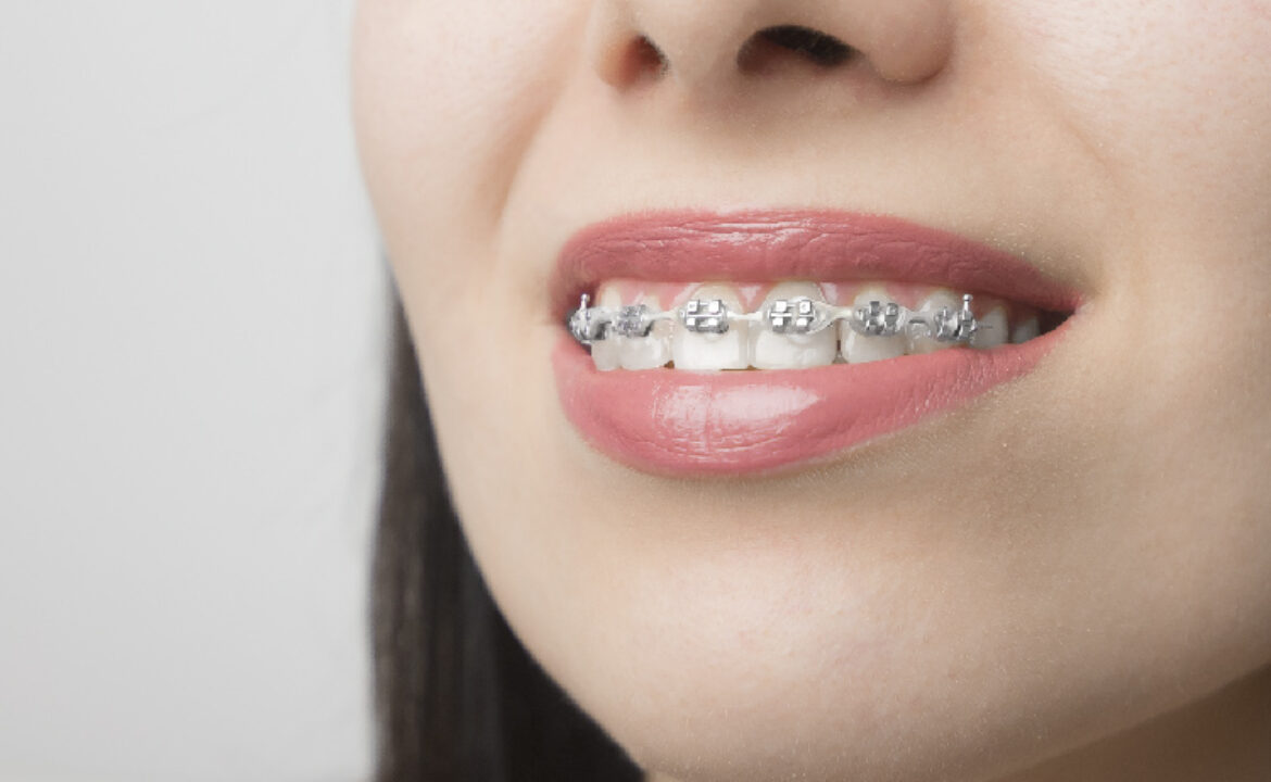 brackets ortodoncia