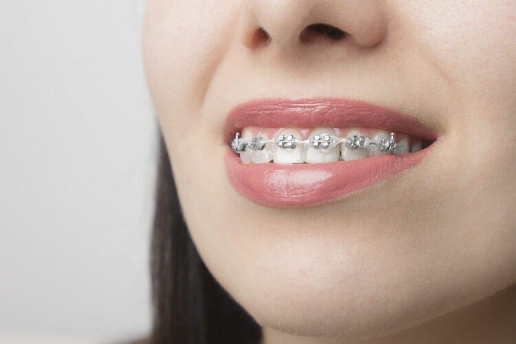 brackets ortodoncia