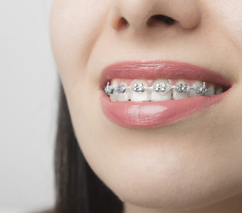 brackets ortodoncia