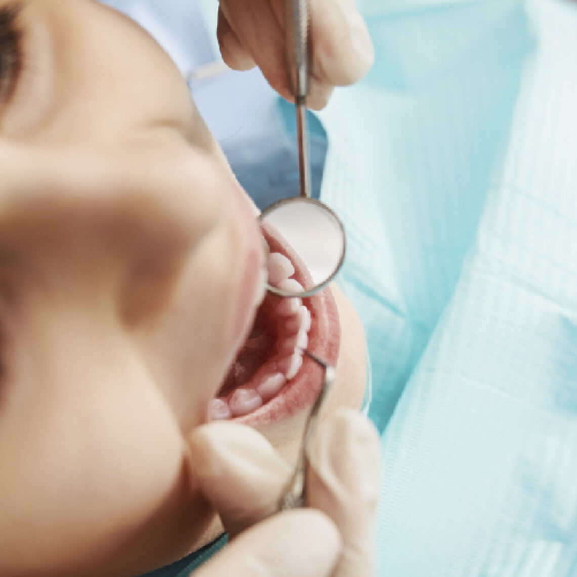 periodontitis