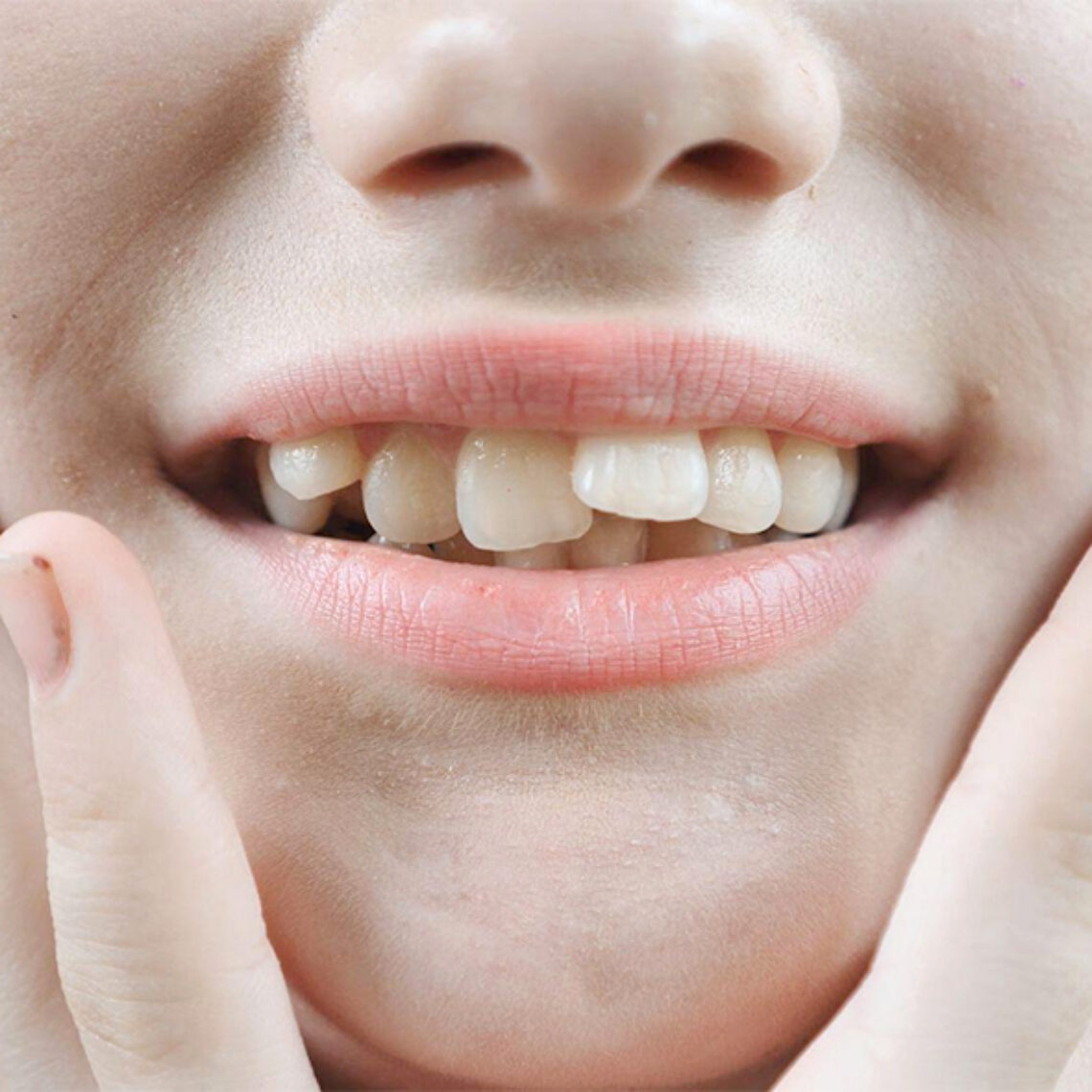 Dientes apiñados
