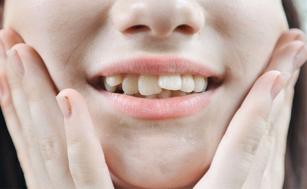Dientes apiñados
