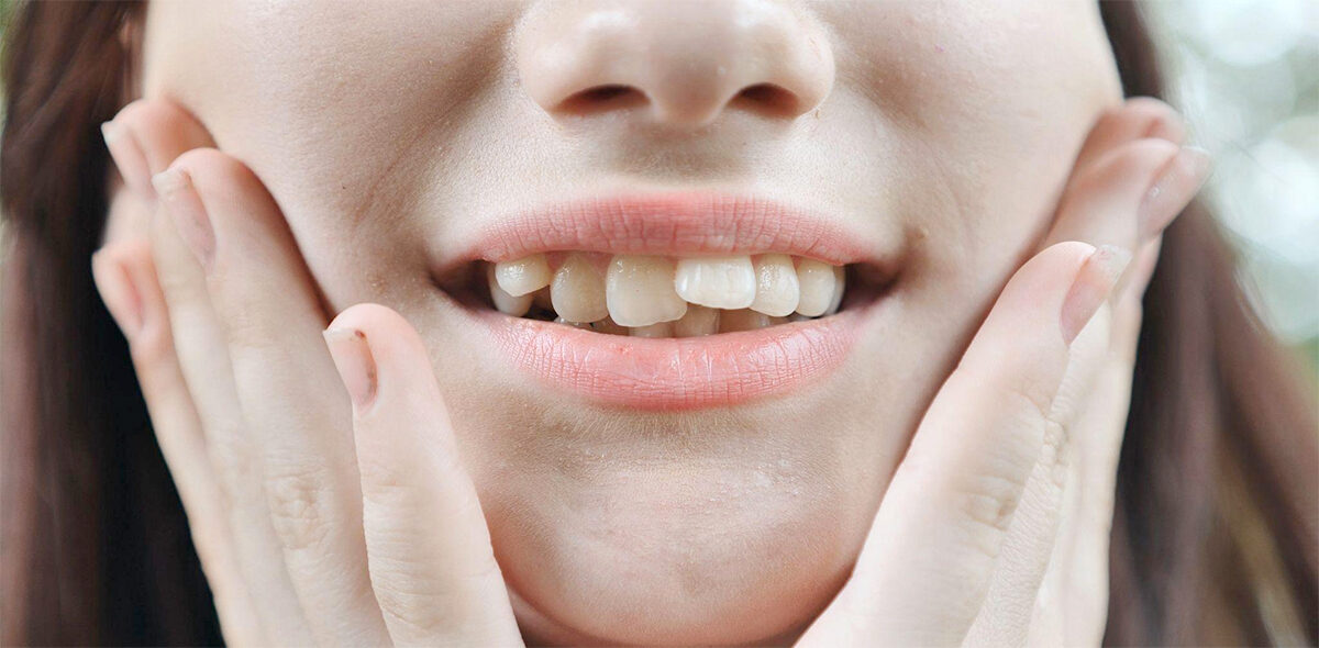 Dientes apiñados