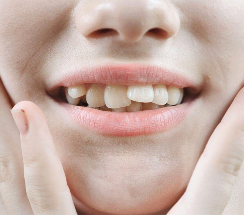 Dientes apiñados