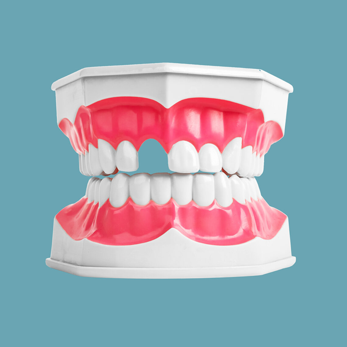 Edentulismo. Falta de dientes.