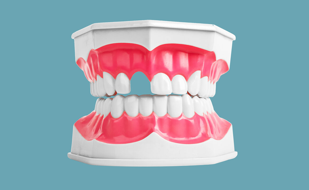 Edentulismo. Falta de dientes.
