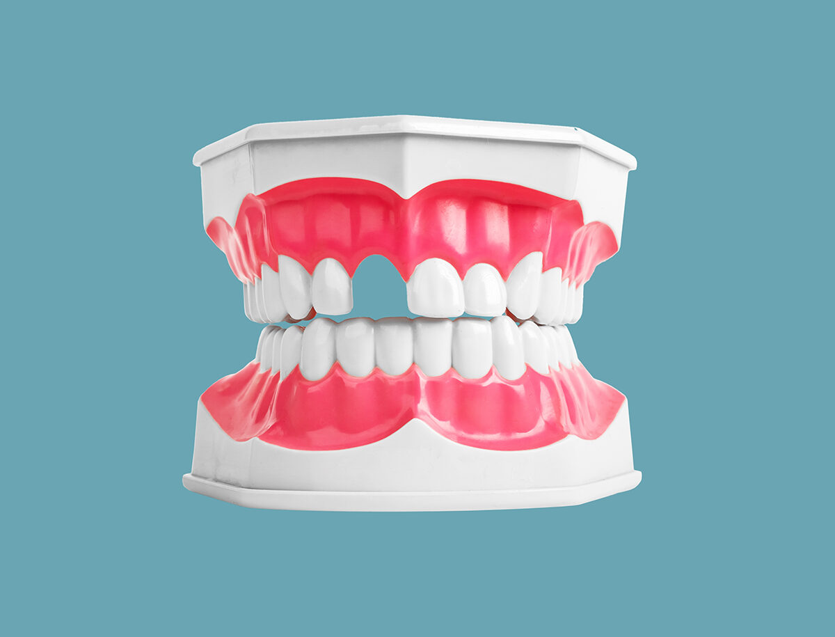 Edentulismo. Falta de dientes.