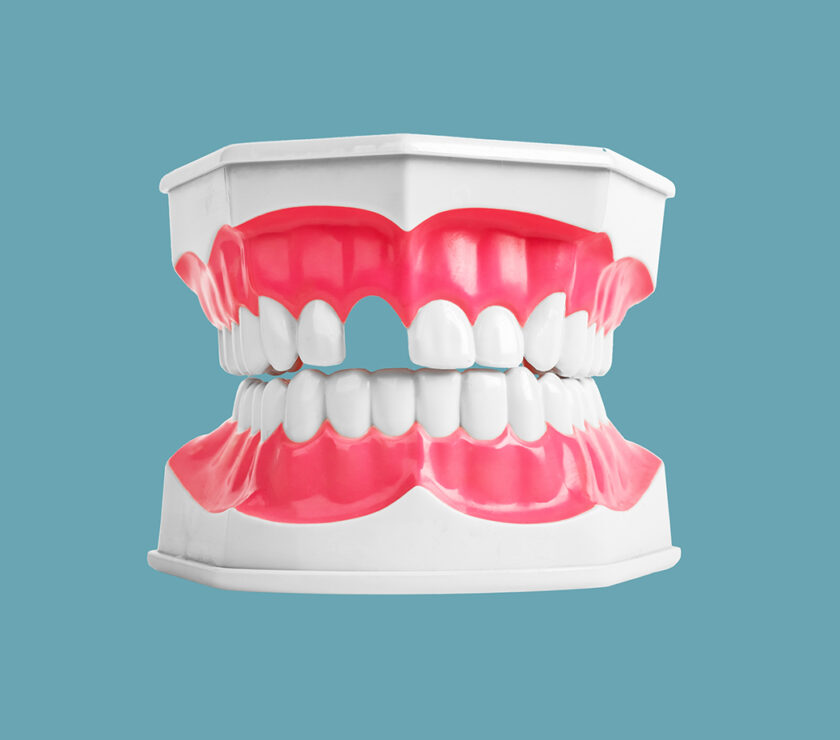 Edentulismo. Falta de dientes.