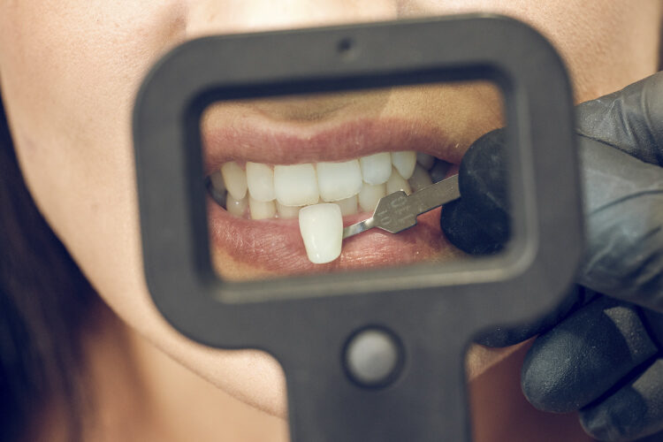 carillas dentales