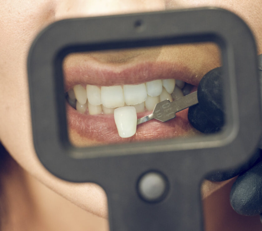 carillas dentales