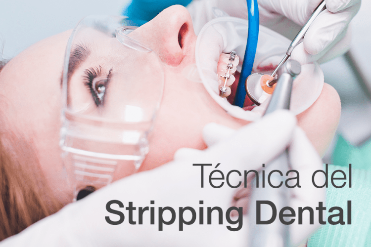 Stripping Dental