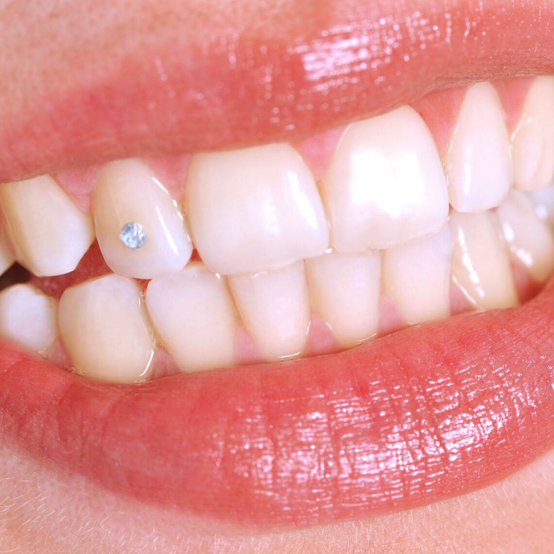 Grillz dental y joyas dentales