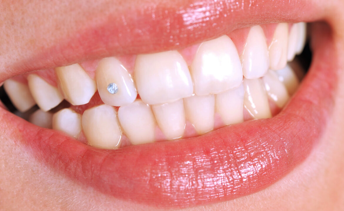 Grillz dental y joyas dentales